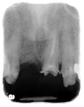 拔牙後x光片,將骨粉填滿拔牙後的齒槽骨.JPG