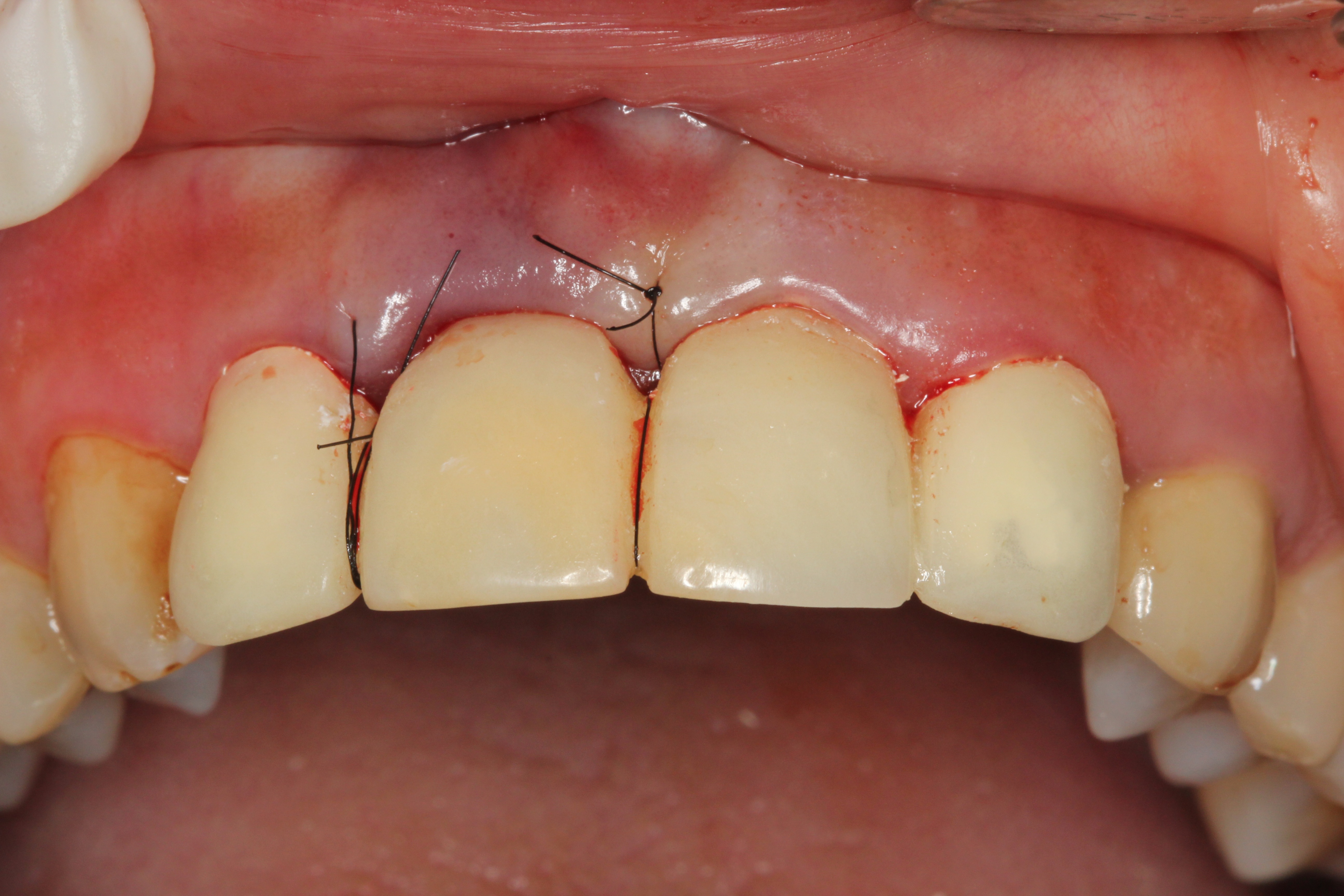 無創傷拔牙後，置入骨粉並立即給予臨時性假牙.JPG
