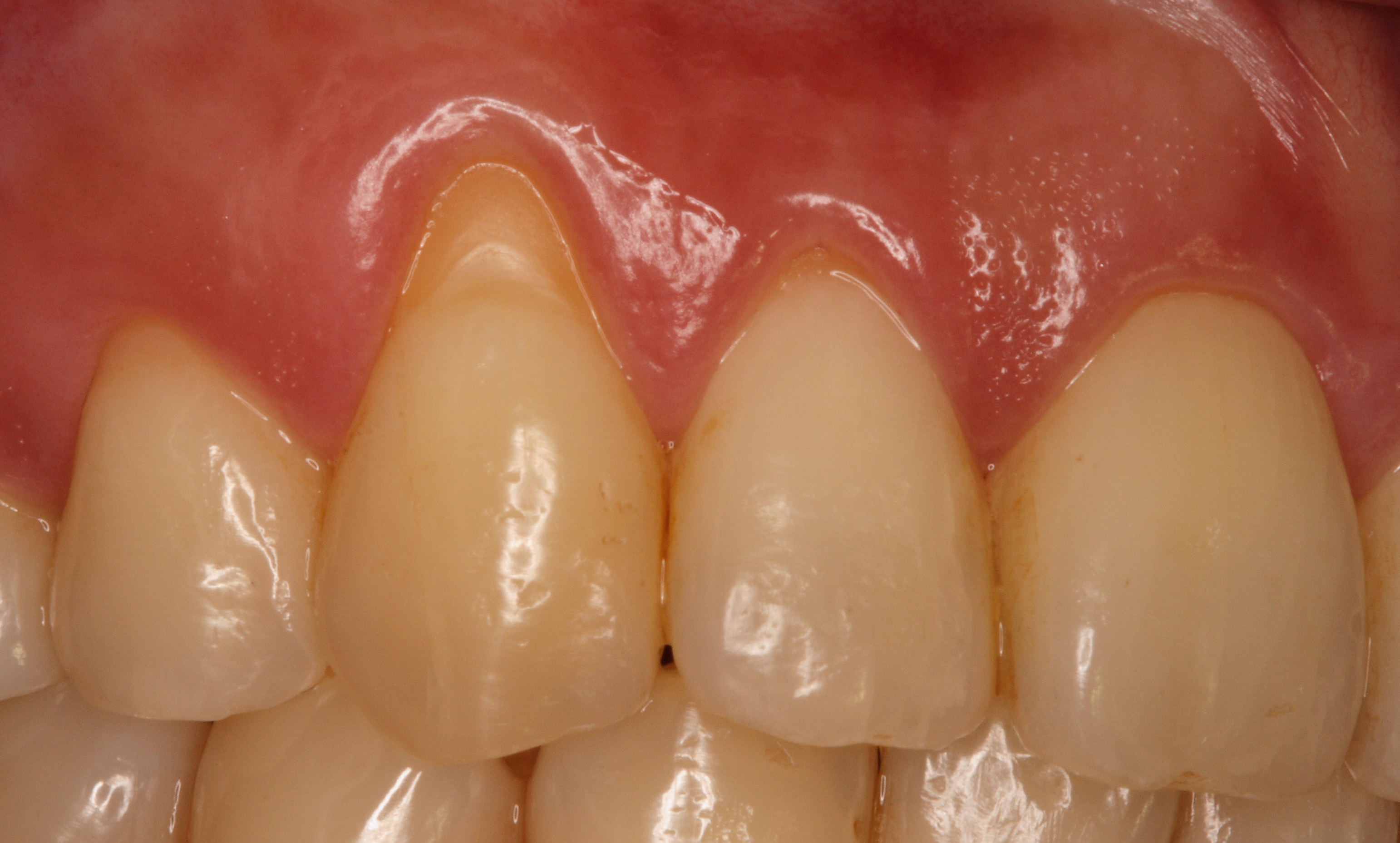 術前：右上犬齒因刷牙不當造成牙齦萎縮牙根外露，而有嚴重敏感問題。.JPG
