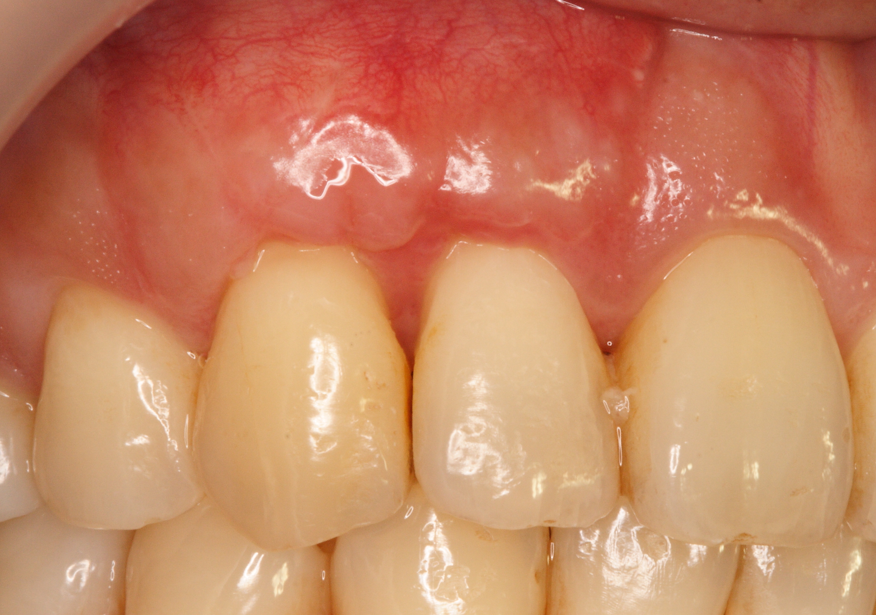 術後：原先暴露的牙根重新被牙肉覆蓋，牙齦明顯增厚，可避免日後再度萎縮。 (案例照片由陳智龍醫師提供).JPG